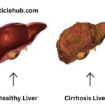 Liver cirrhosis is the last stage of the liver, in this situation, healthy liver tissues are replaced through scar tissue, which results in liver damage.